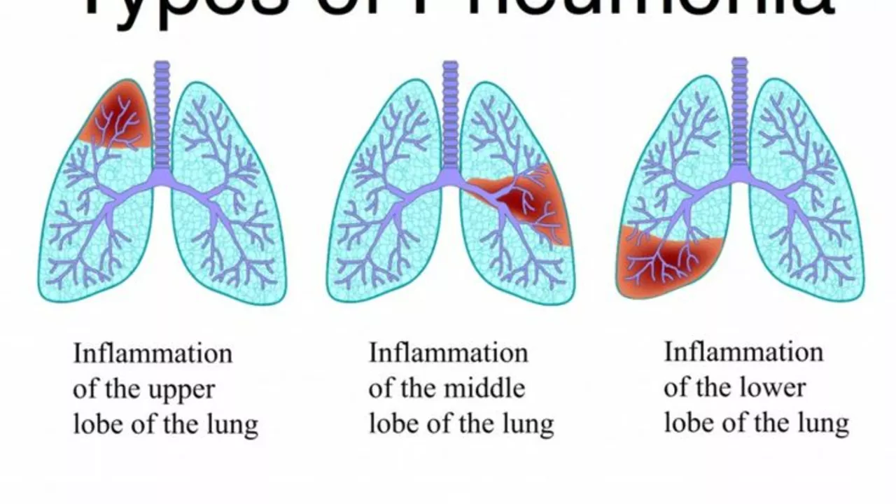 How to Manage Pneumonia Symptoms at Home